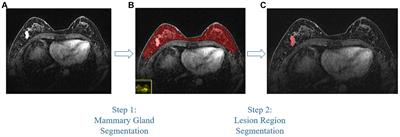 Pathologic complete response prediction in breast cancer lesion segmentation and neoadjuvant therapy